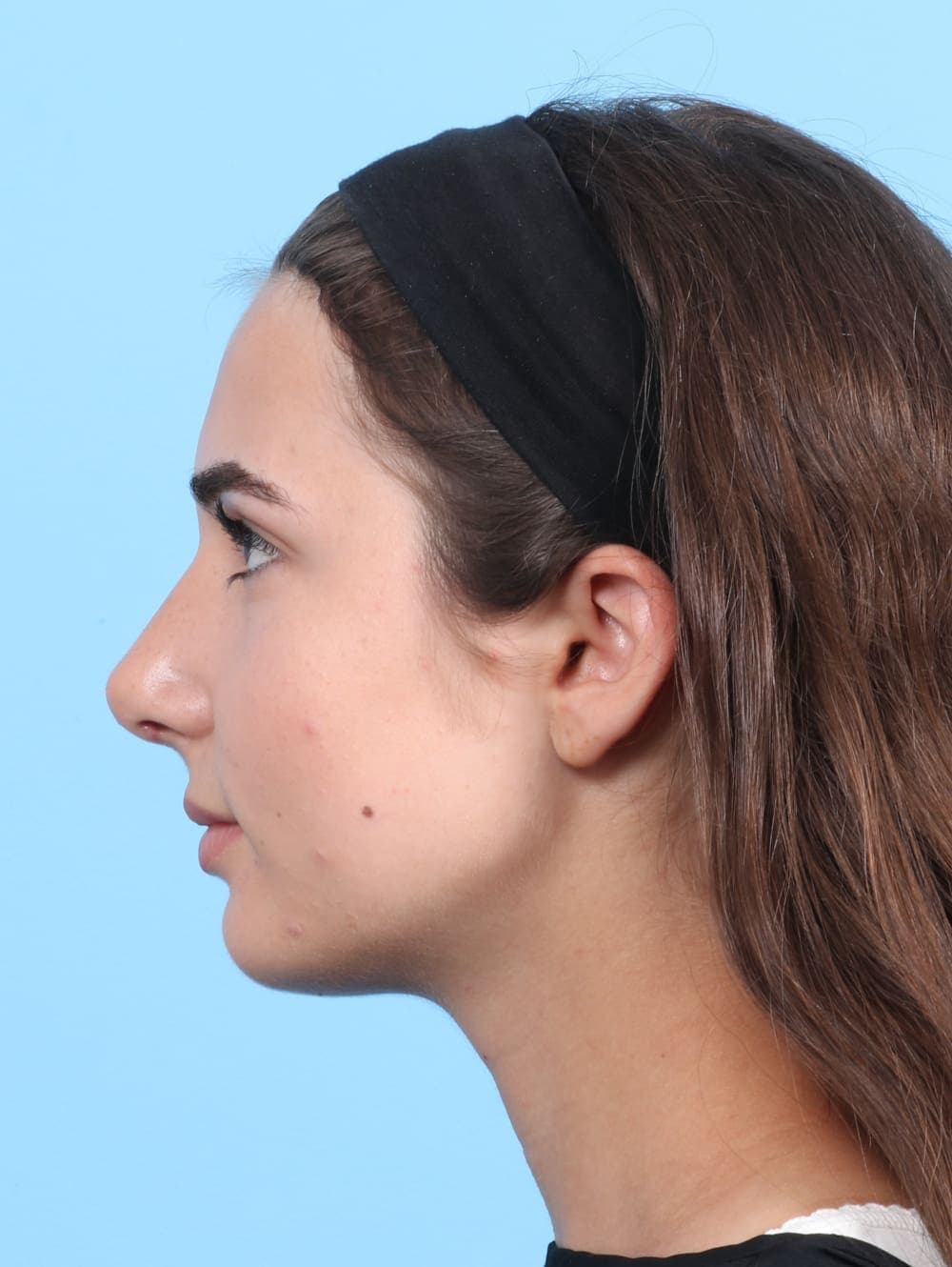 Rhinoplasty case #2679 after, image 1