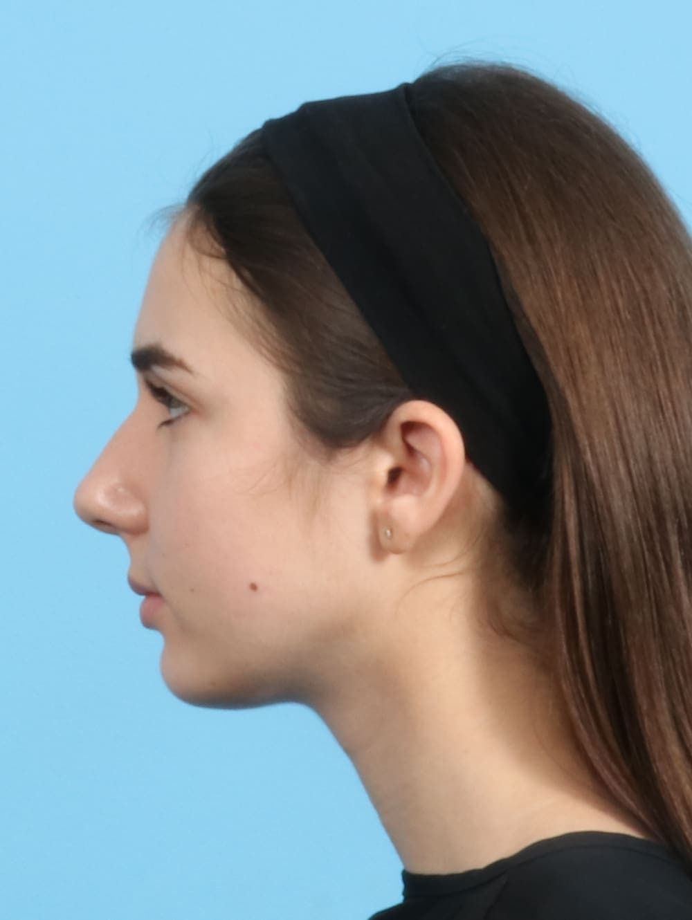Rhinoplasty case #2679 before, image 1