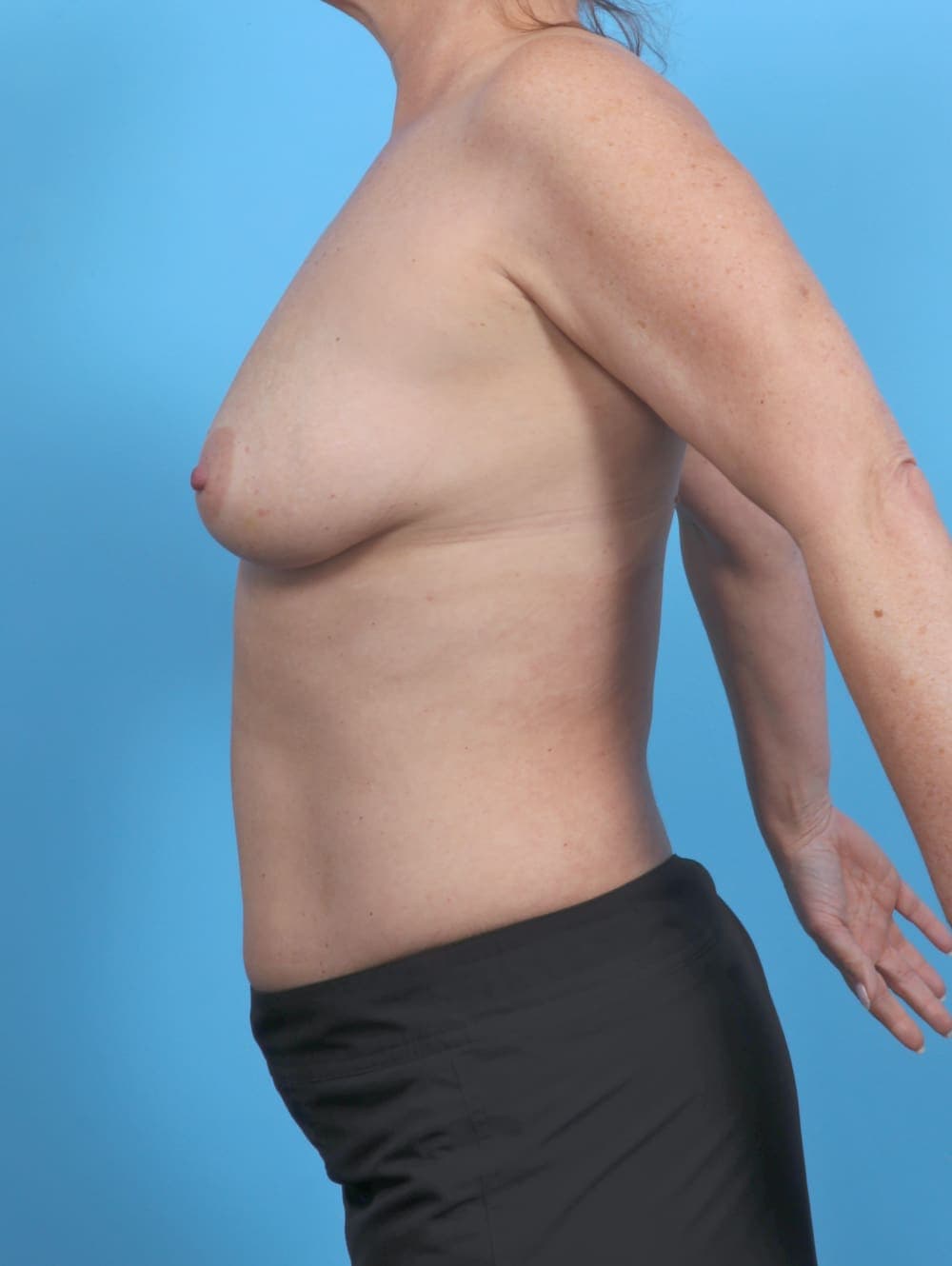 Breast Lift with Implants case #6042 before, image 3