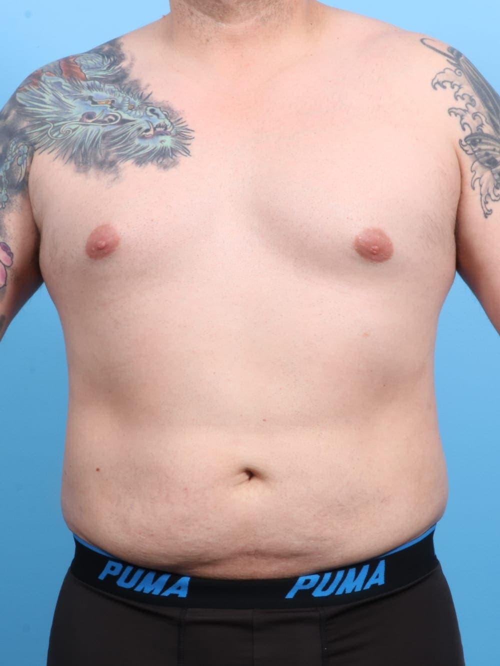 Liposuction case #1220 after, image 1