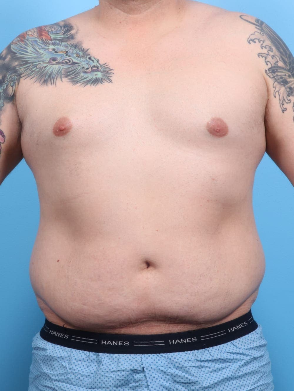 Liposuction case #1220 before, image 1