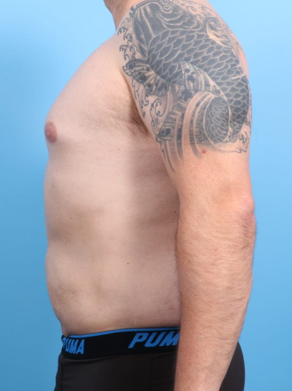 Liposuction case #1220 after, image 3