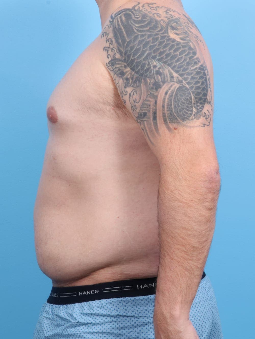 Liposuction case #1220 before, image 3