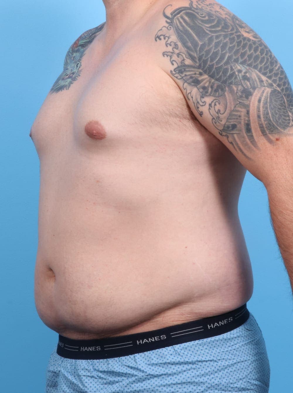 Liposuction case #1220 before, image 2