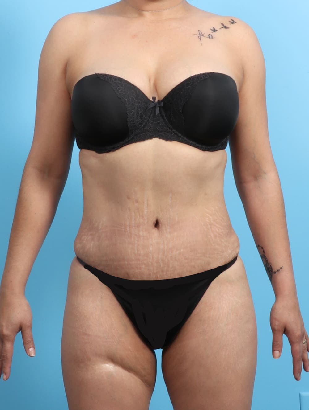 Liposuction case #2298 after, image 1