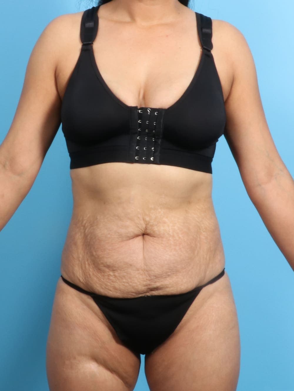 Liposuction case #2298 before, image 1