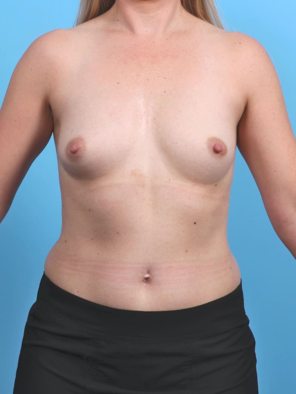 Breast Augmentation case #5466 before, image 1