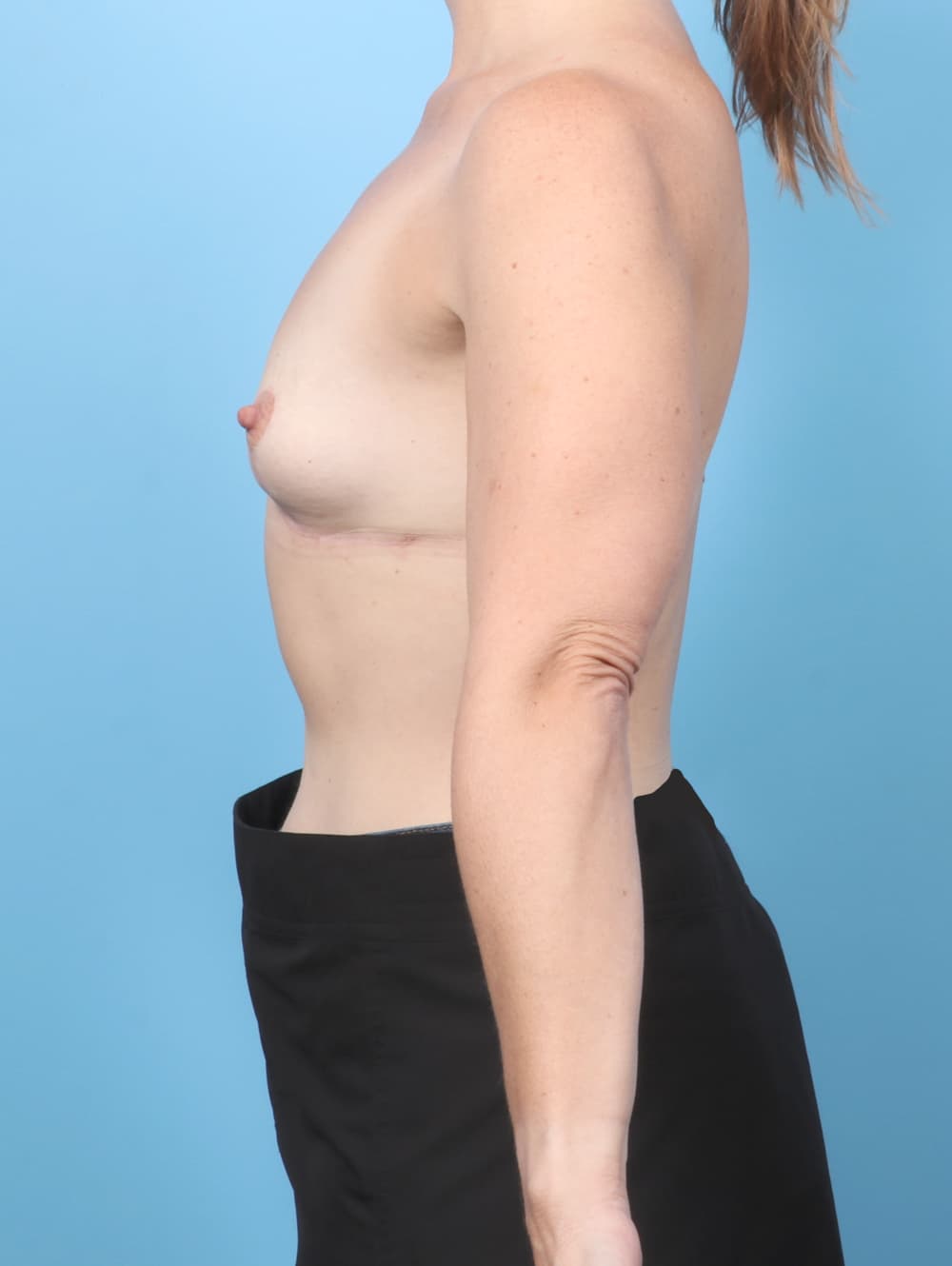 Breast Implant Removal with Lift case #7936 after, image 3