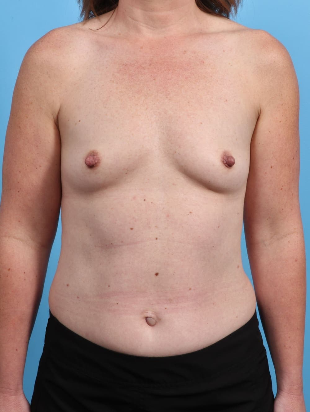 Breast Augmentation case #3819 before, image 1