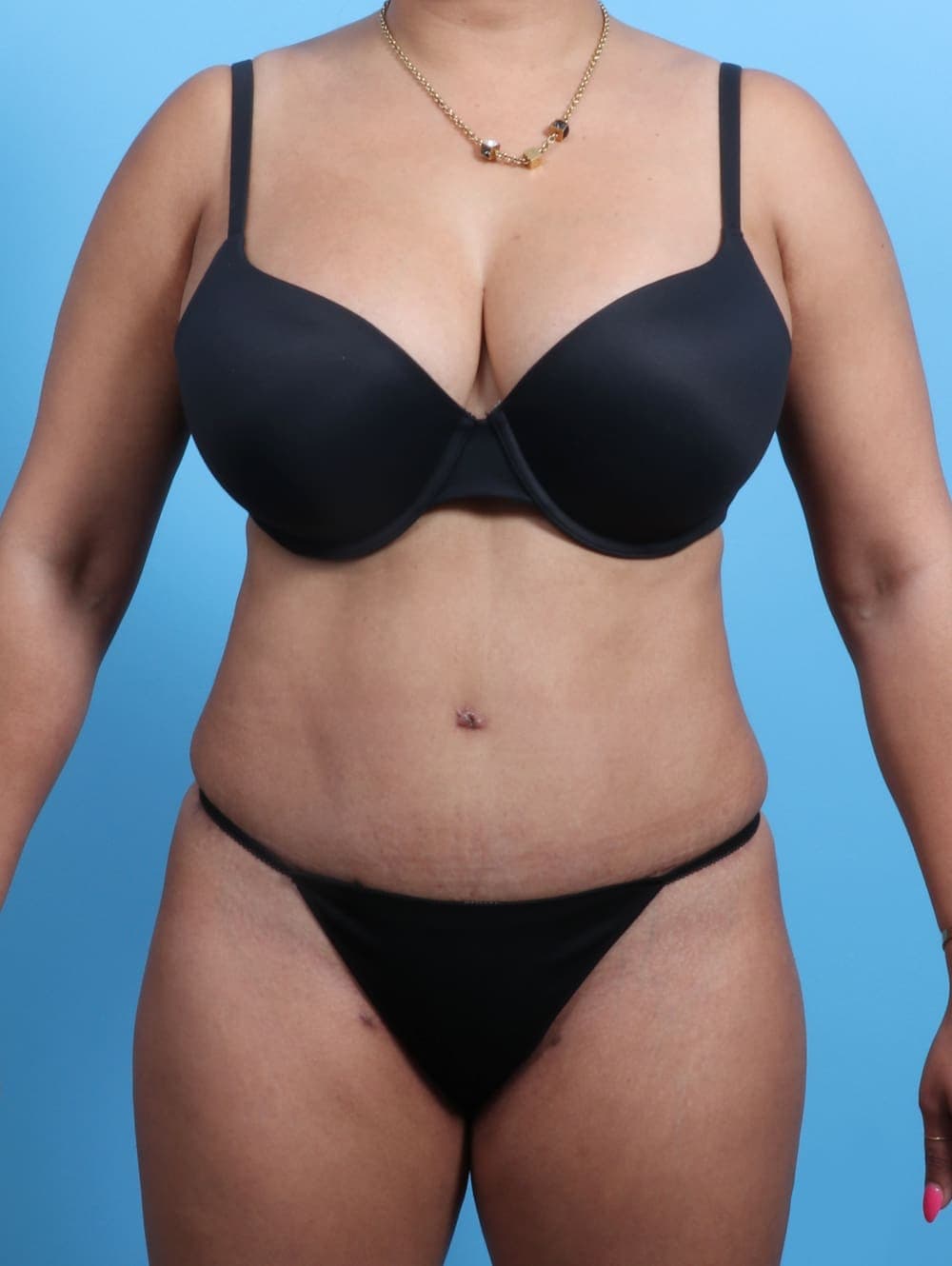 Tummy Tuck case #2362 after, image 1