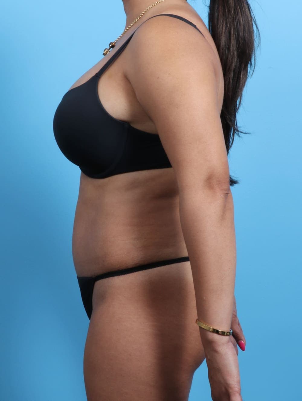 Tummy Tuck case #2362 after, image 3