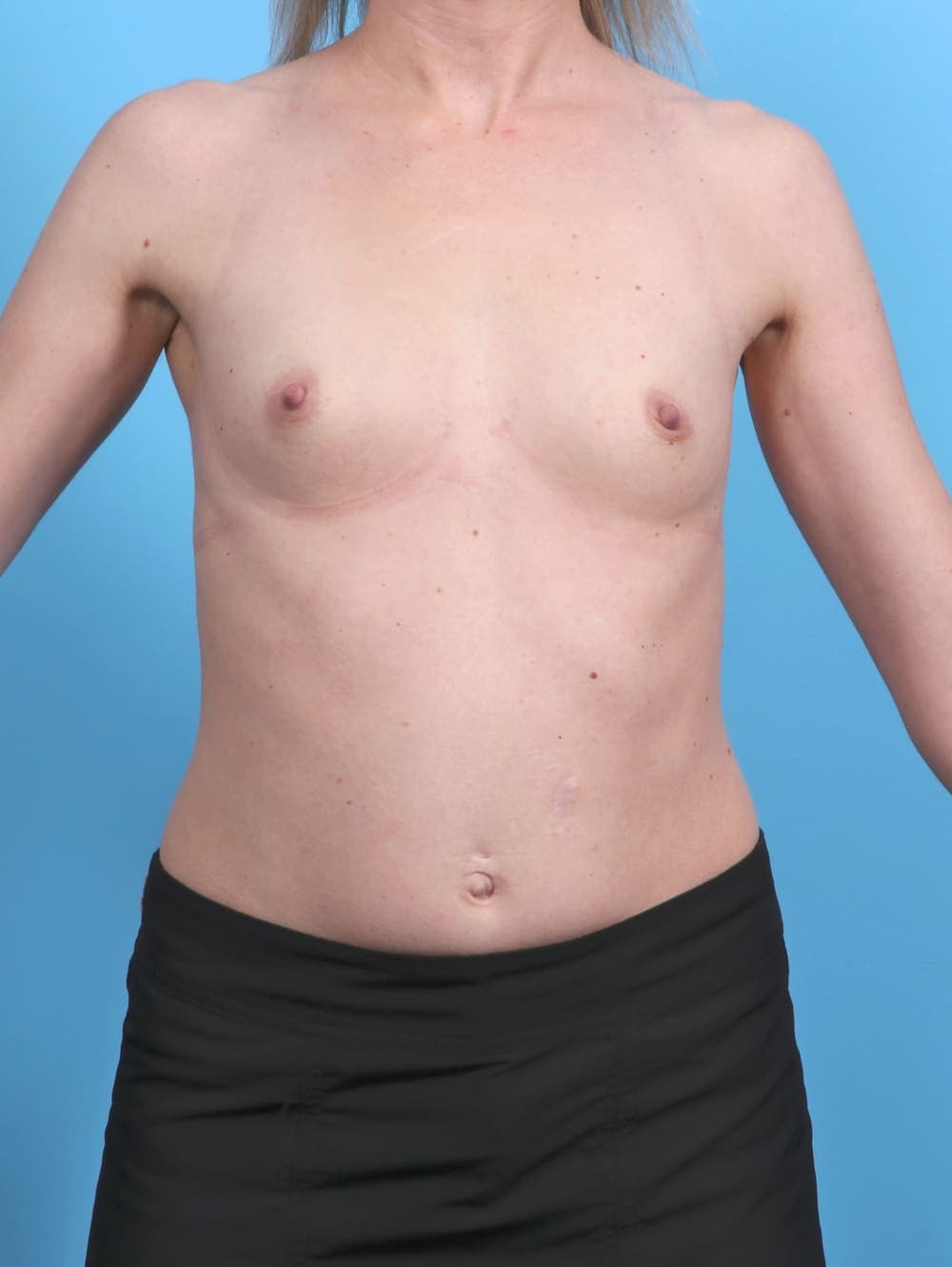 Breast Augmentation case #5747 before, image 1