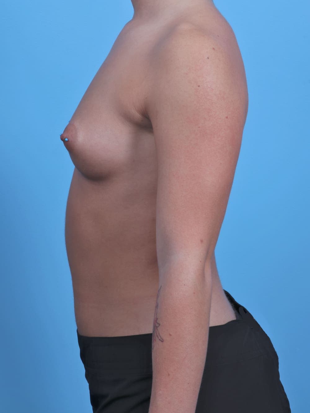 Breast Augmentation case #4313 before, image 3
