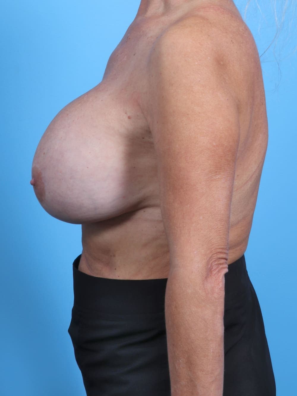 Breast Implant Revision case #3578 before, image 3