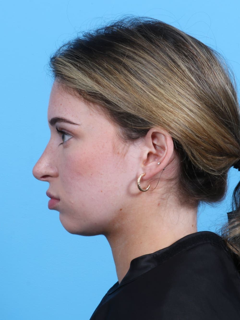 Rhinoplasty case #3153 after