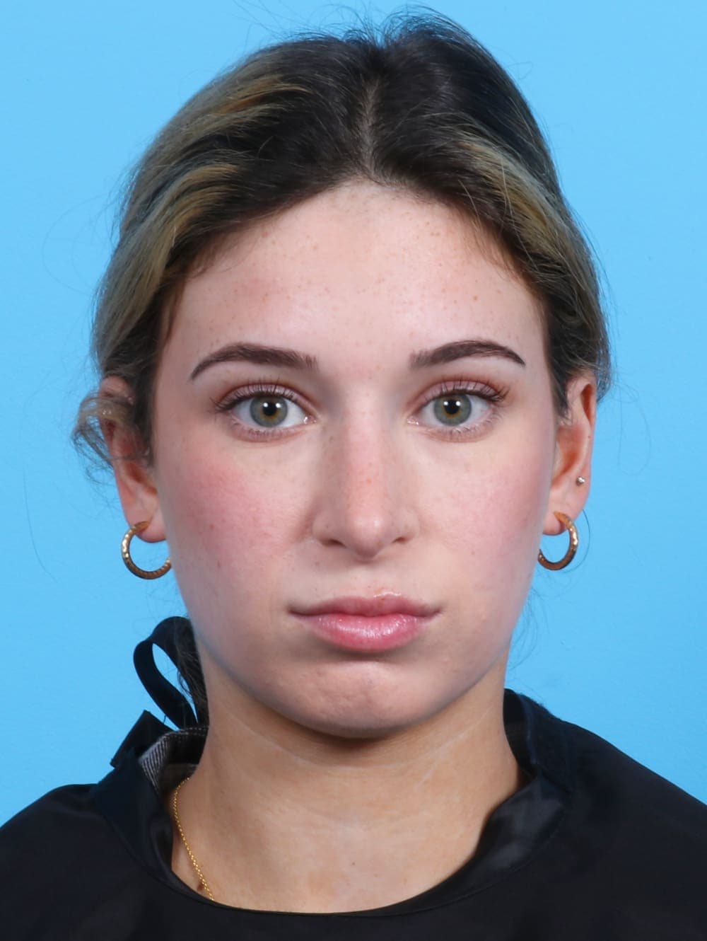 Rhinoplasty case #3153 after, image 2