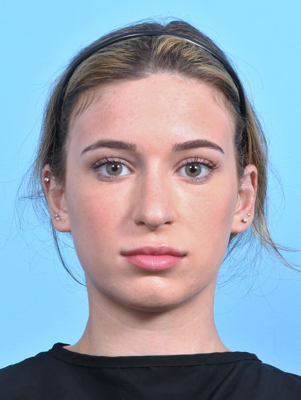 Rhinoplasty case #3153 before, image 2