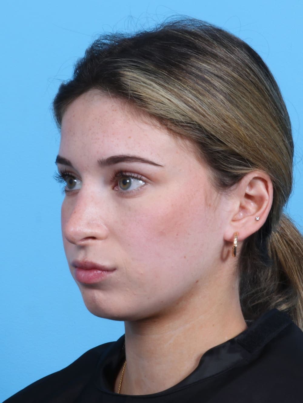 Rhinoplasty case #3153 after, image 3