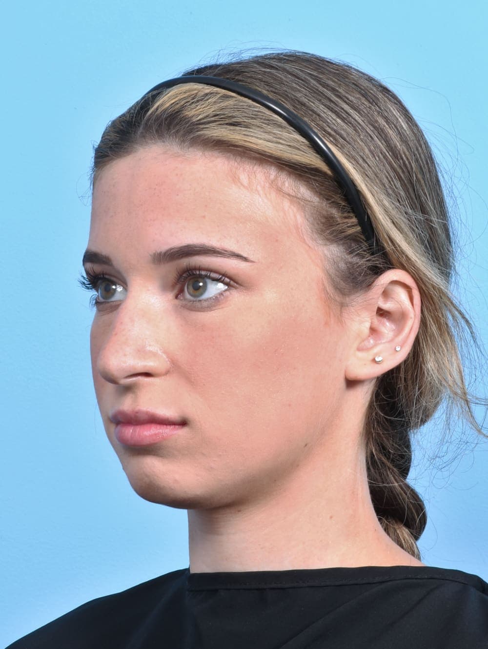 Rhinoplasty case #3153 before, image 3
