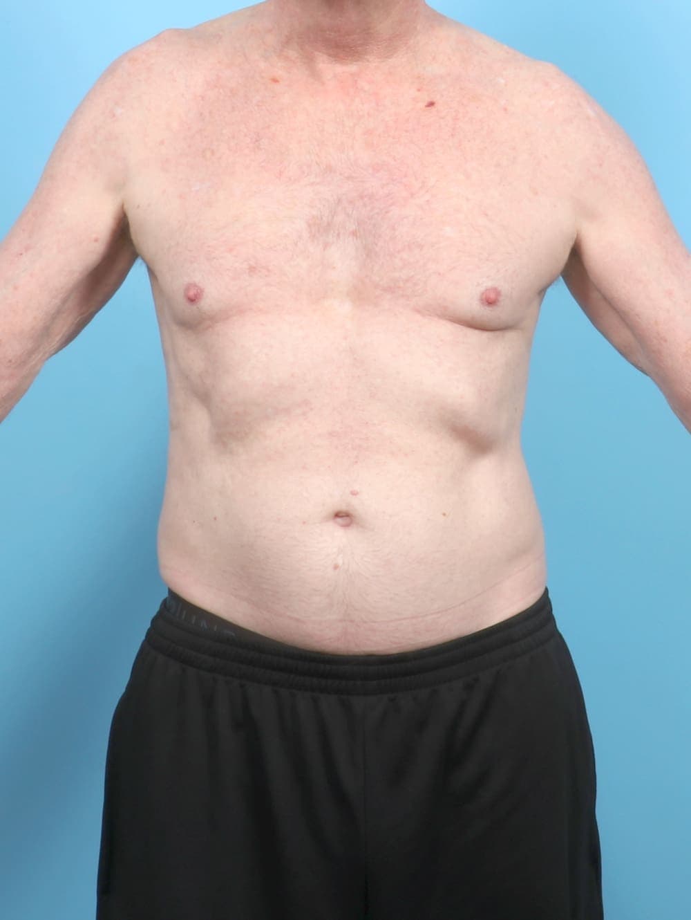 Male Breast Reduction case #6443 before