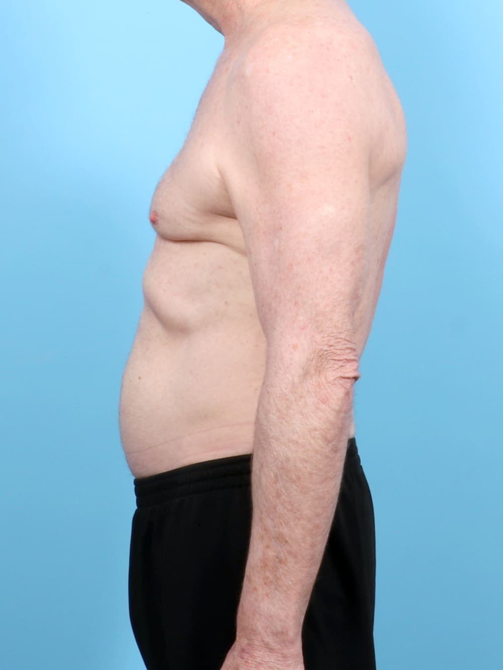 Male Breast Reduction case #6443 before, image 3