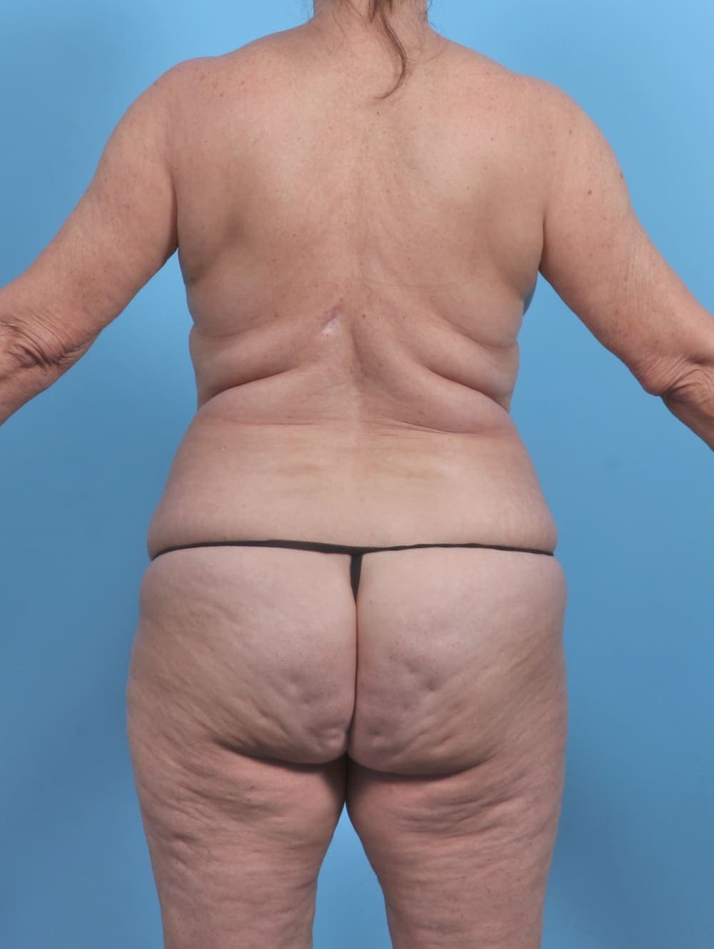 Mommy Makeover case #5847 before, image 4