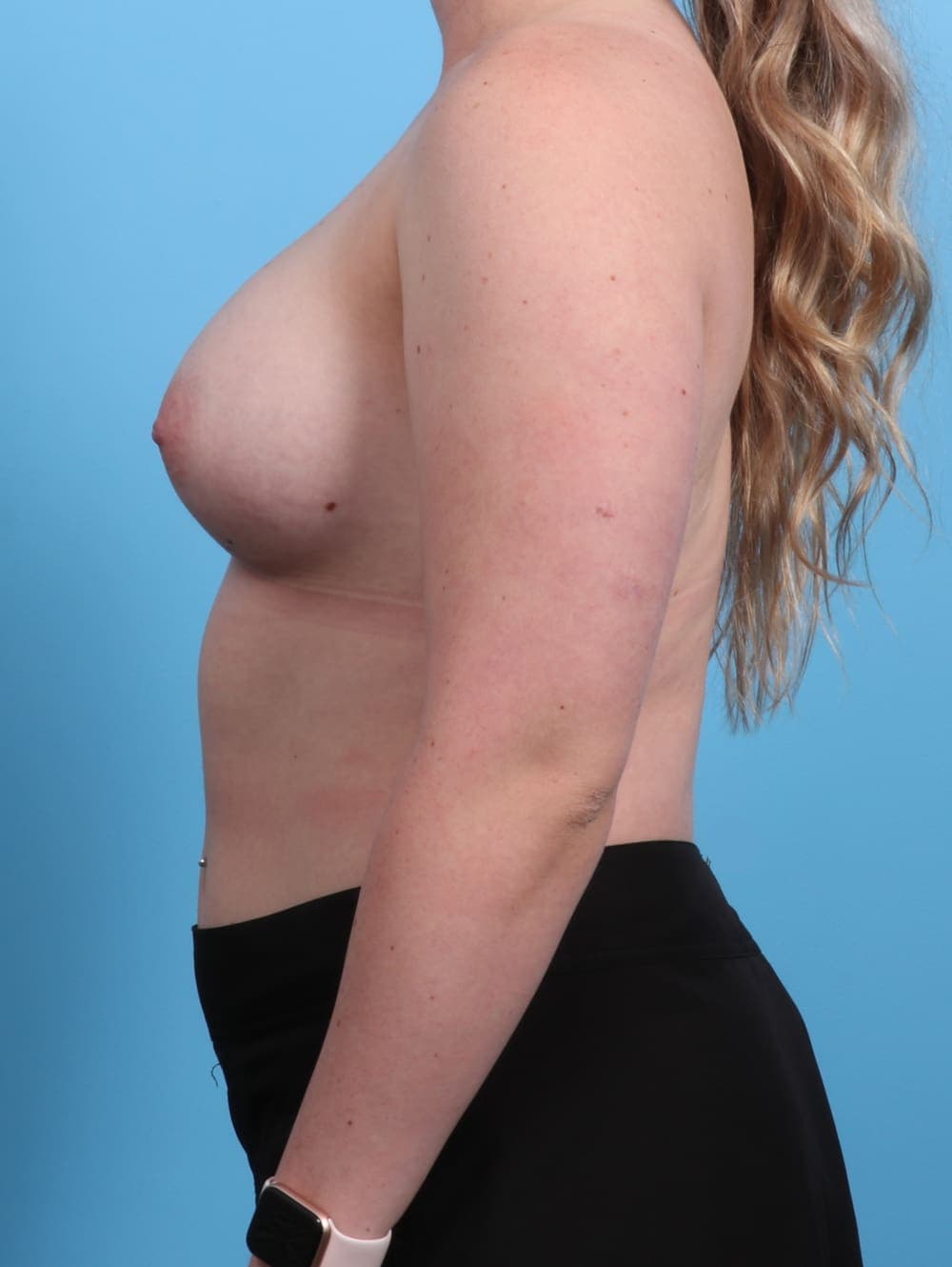 Breast Augmentation case #2889 after, image 3