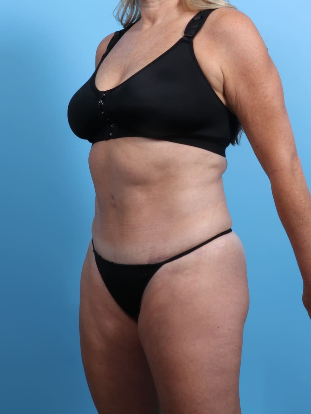 Tummy Tuck case #2833 after, image 2