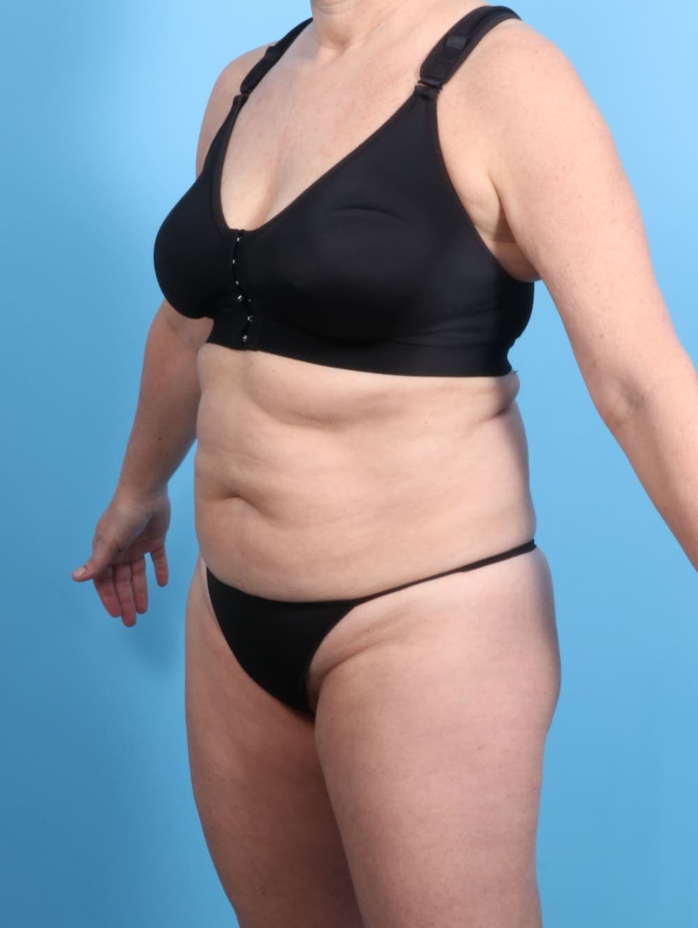 Tummy Tuck case #2833 before, image 2
