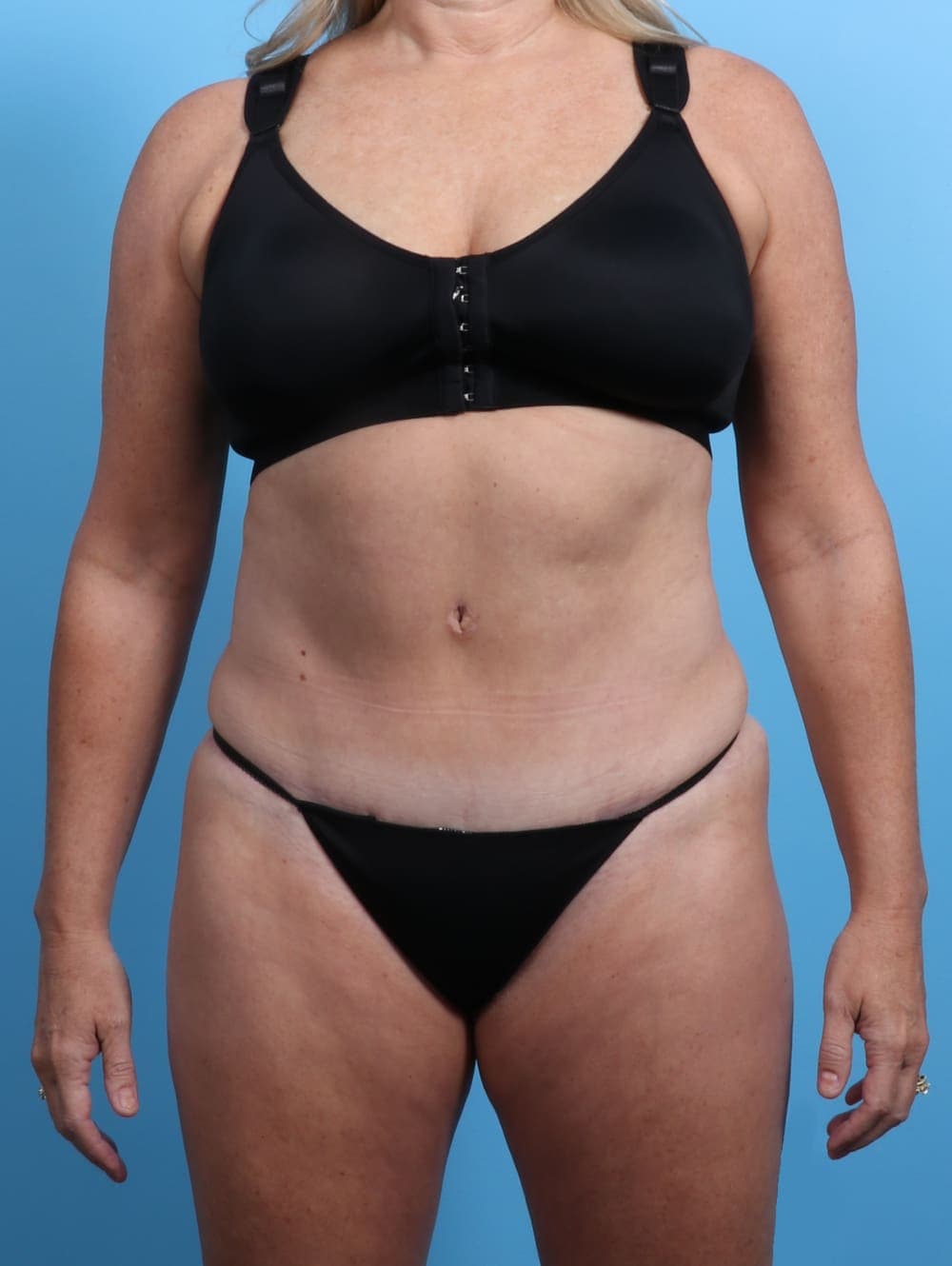 Tummy Tuck case #2833 after, image 1