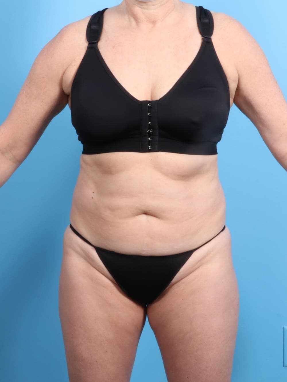 Tummy Tuck case #2833 before, image 1