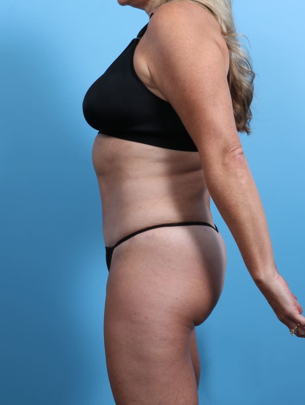 Tummy Tuck case #2833 after, image 3