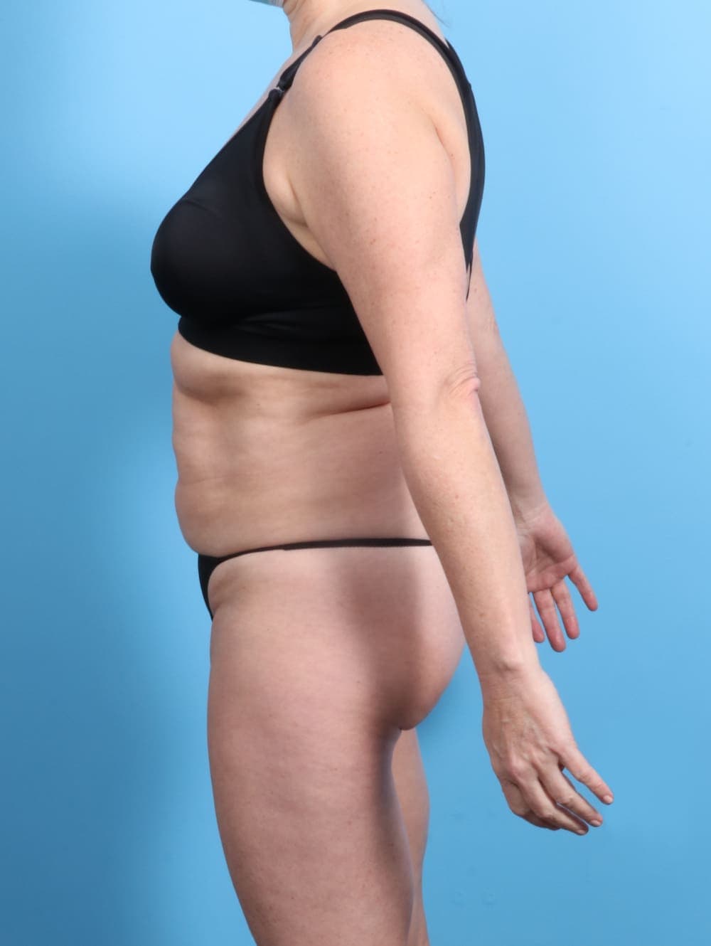 Tummy Tuck case #2833 before, image 3