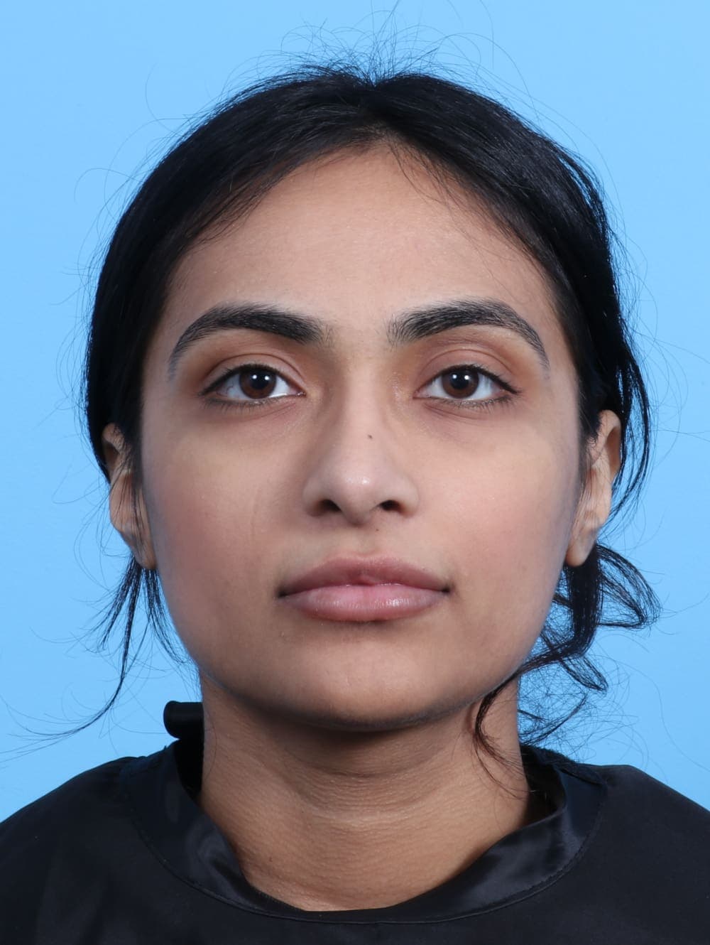 Rhinoplasty case #2979 after, image 2