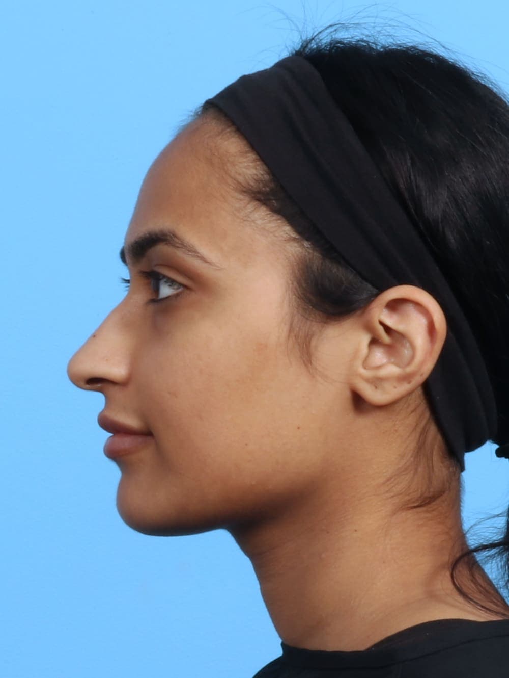 Rhinoplasty case #2979 before