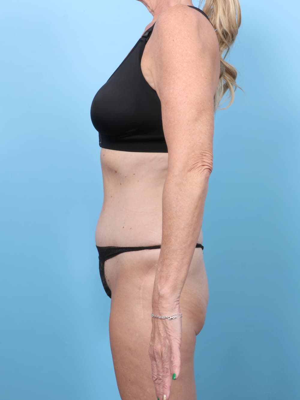Tummy Tuck case #7726 after, image 3