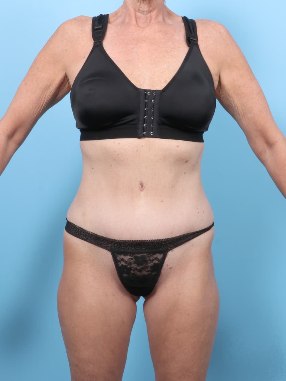 Tummy Tuck case #7726 after, image 1