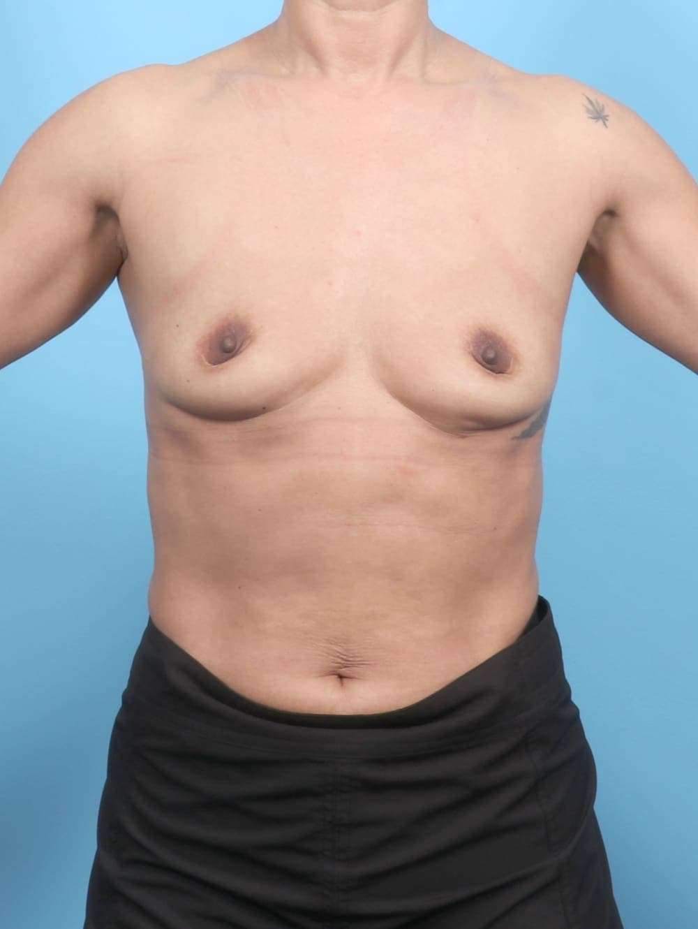 Breast Augmentation case #6669 before, image 1