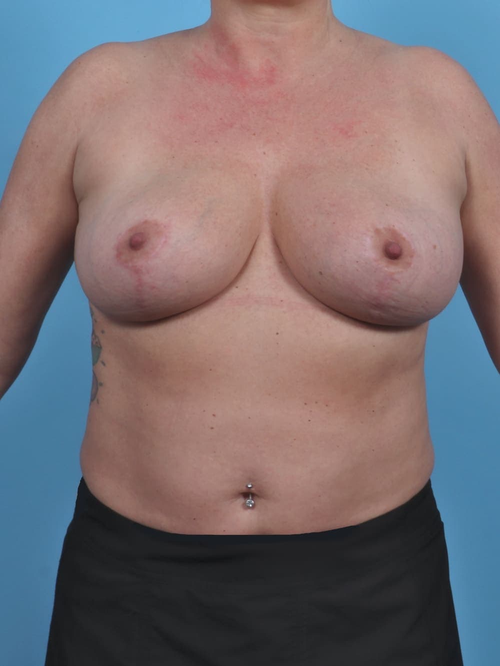 Breast Lift/Reduction case #4926 after, image 1