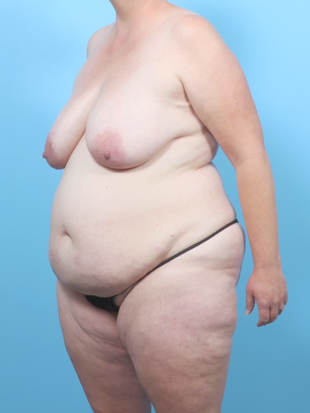 Mommy Makeover case #7006 before, image 2