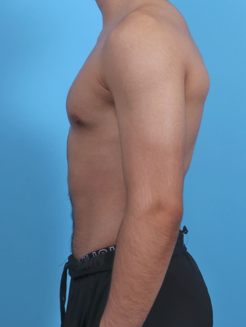 Male Breast Reduction case #3906 after, image 3