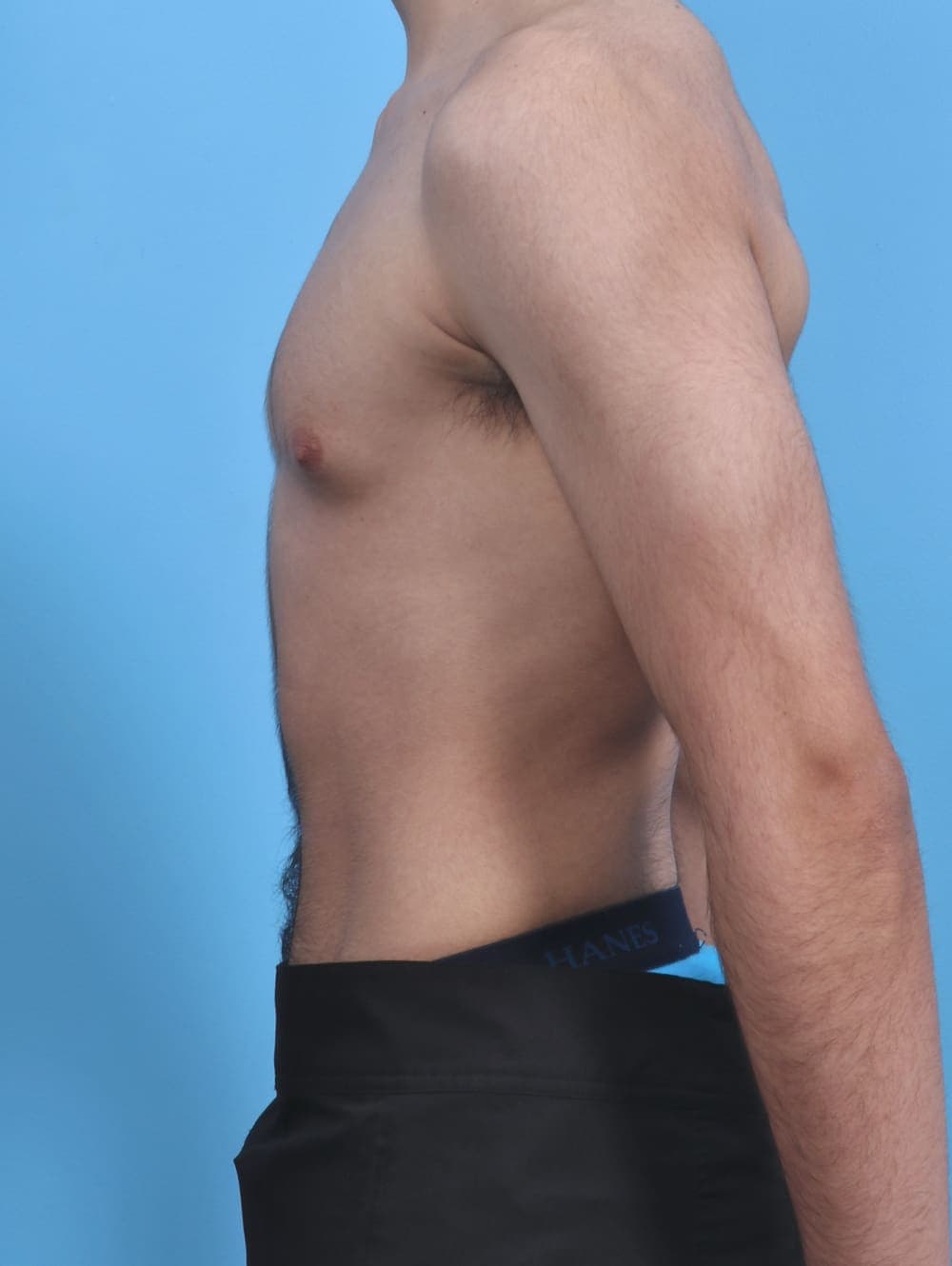 Male Breast Reduction case #3906 before, image 3