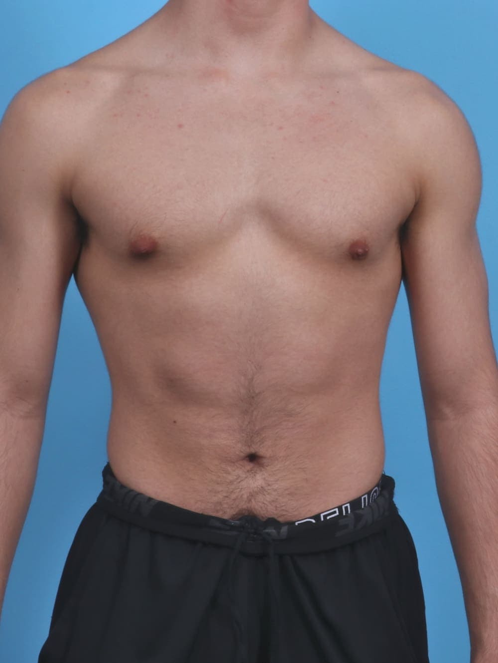Male Breast Reduction case #3906 after, image 1