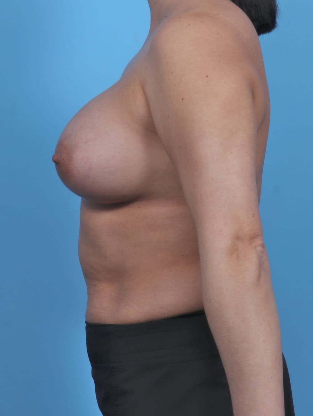 Breast Augmentation case #5021 after, image 3