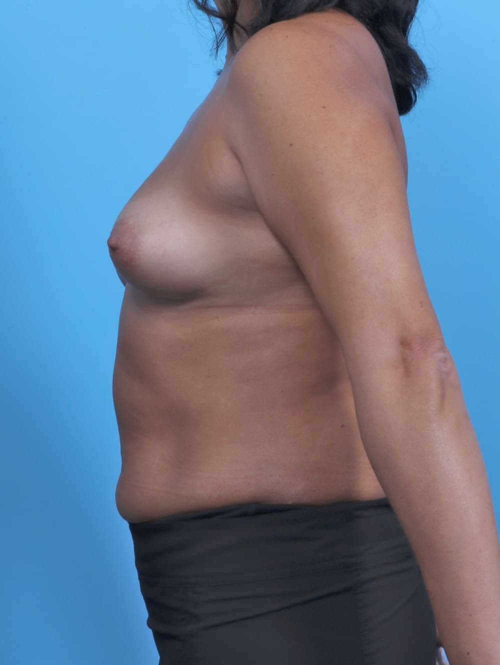 Breast Augmentation case #5021 before, image 3