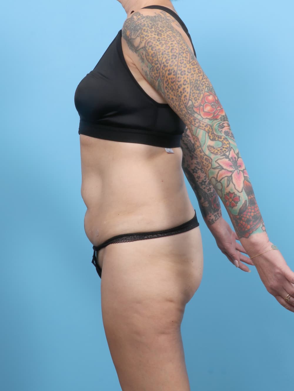 Liposuction case #7676 before, image 3