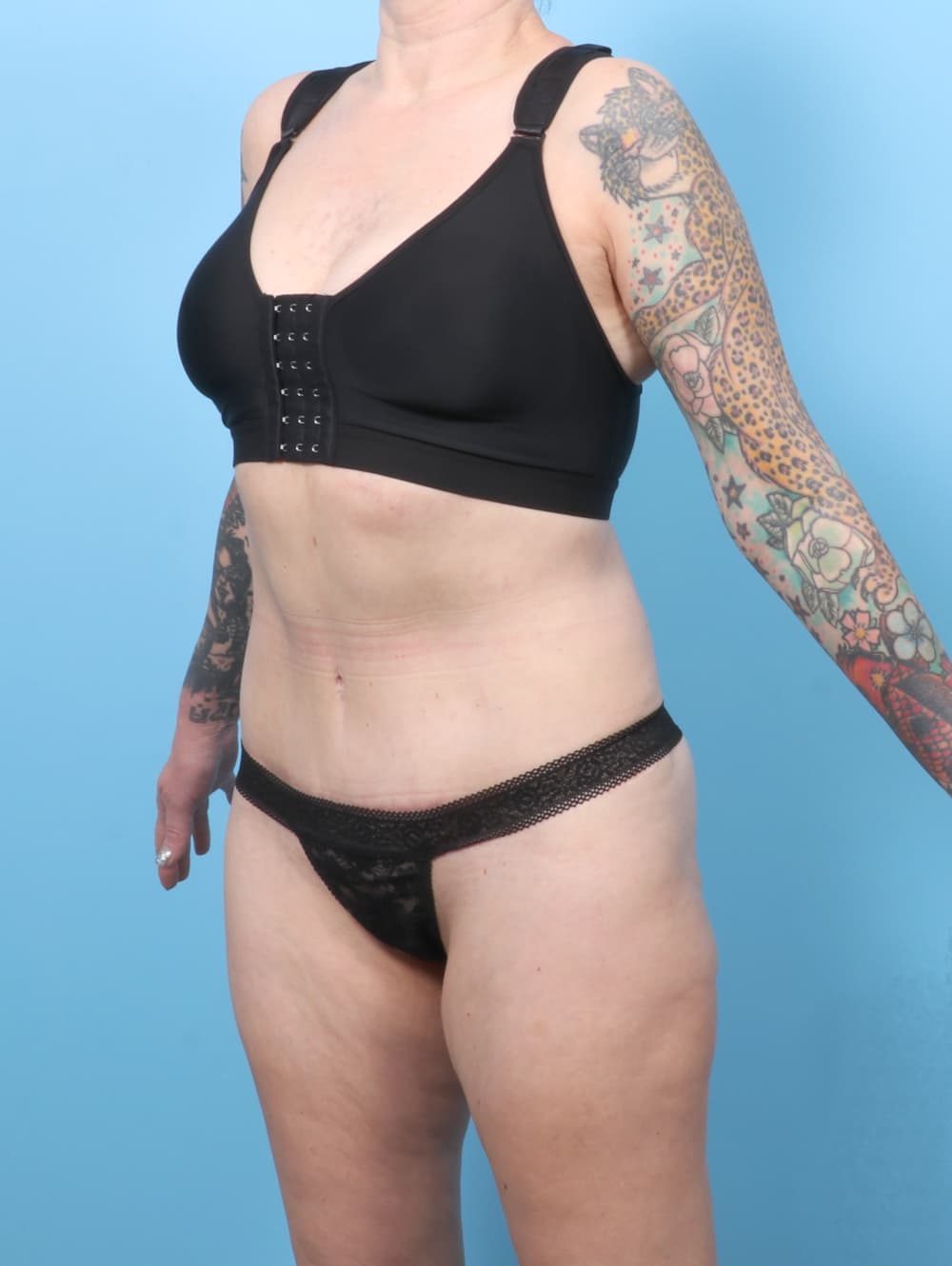 Liposuction case #7676 after, image 2
