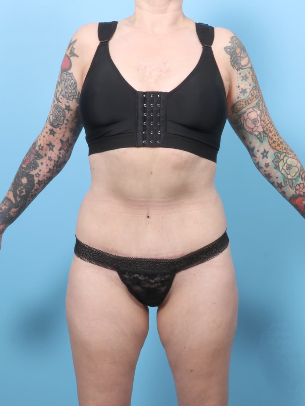 Liposuction case #7676 after, image 1