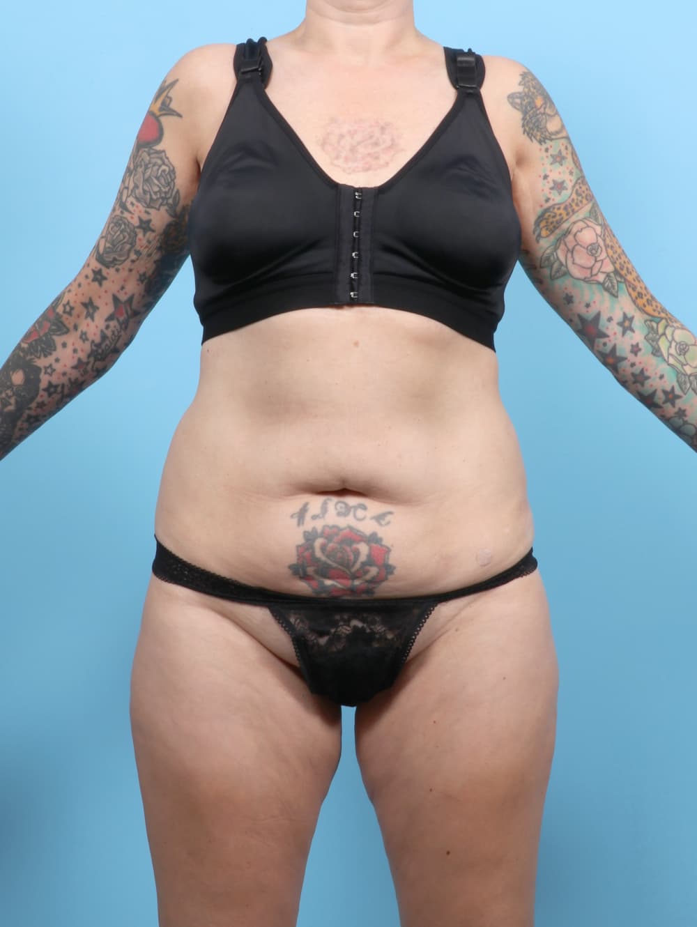 Liposuction case #7676 before, image 1
