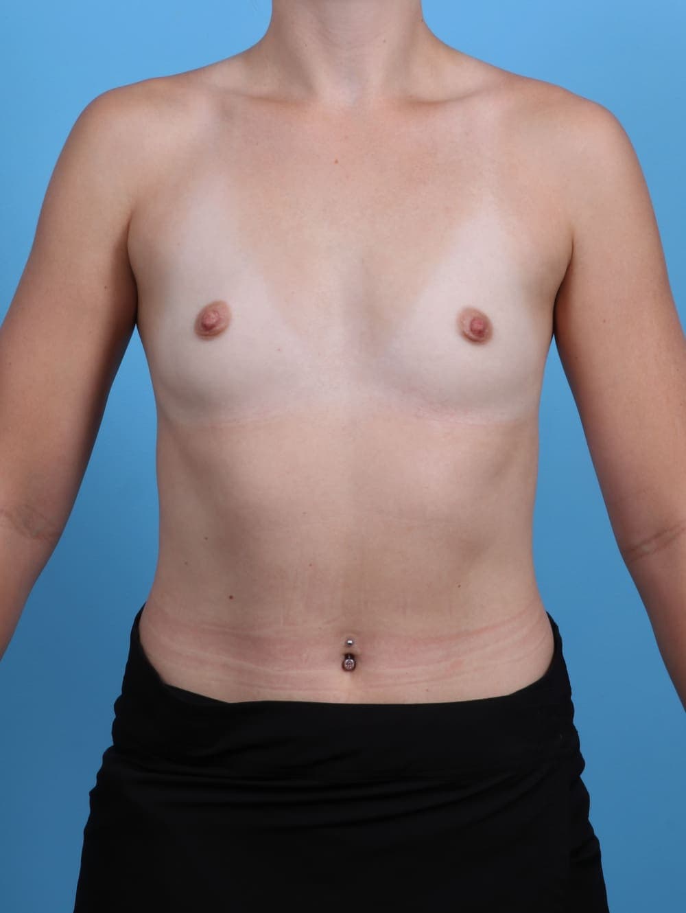 Breast Augmentation case #4902 before, image 1